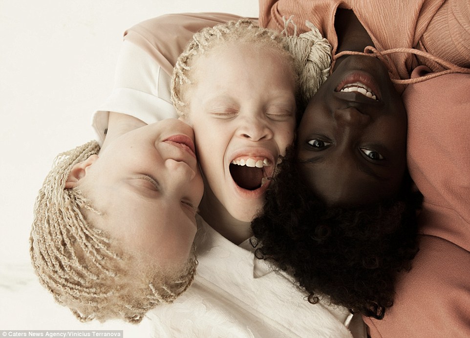 Albinismus, Zwillinge